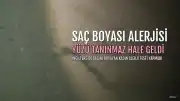 Saçını Boyayan Kadının Yüzü Şişti, Eşi Bile Tanıyamadı