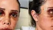 Felç Geçiren Didem Ceran'dan Yeni Estetik Açıklaması