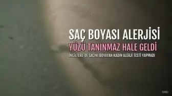 Saçını Boyayan Kadının Yüzü Şişti, Eşi Bile Tanıyamadı