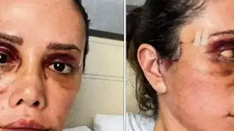 Felç Geçiren Didem Ceran'dan Yeni Estetik Açıklaması